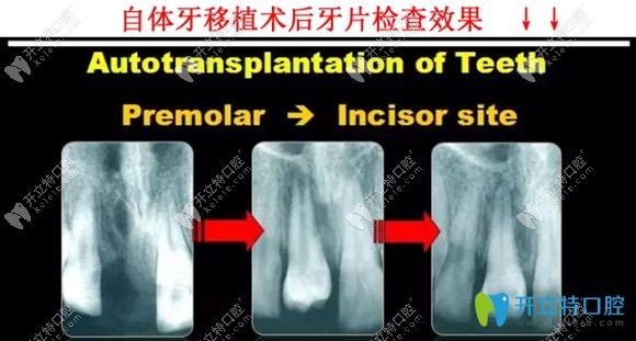 自體牙種植術(shù)后效果
