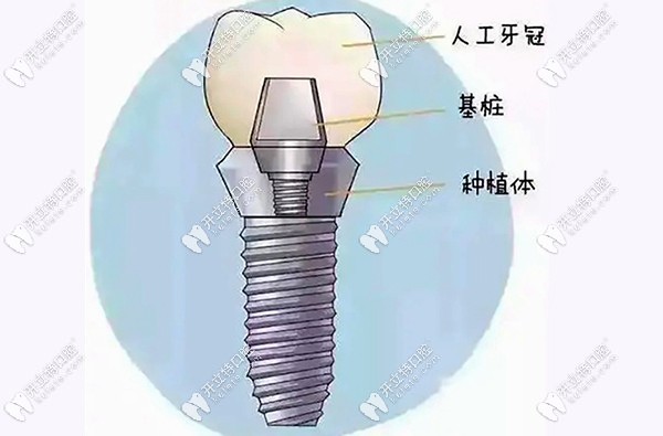 韓國登騰種植體的型號