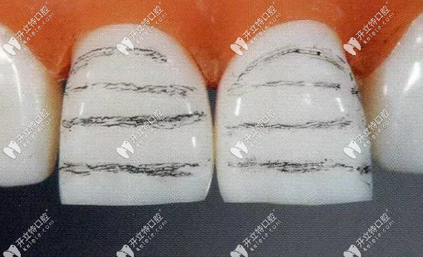 貼面預(yù)備牙齒的模擬圖