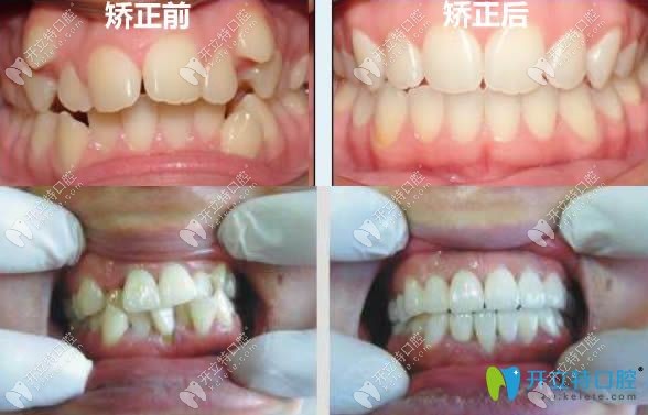成都圣貝牙齒擁擠矯正前后對(duì)比效果