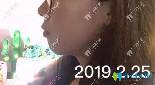掩饰性正畸有用吗