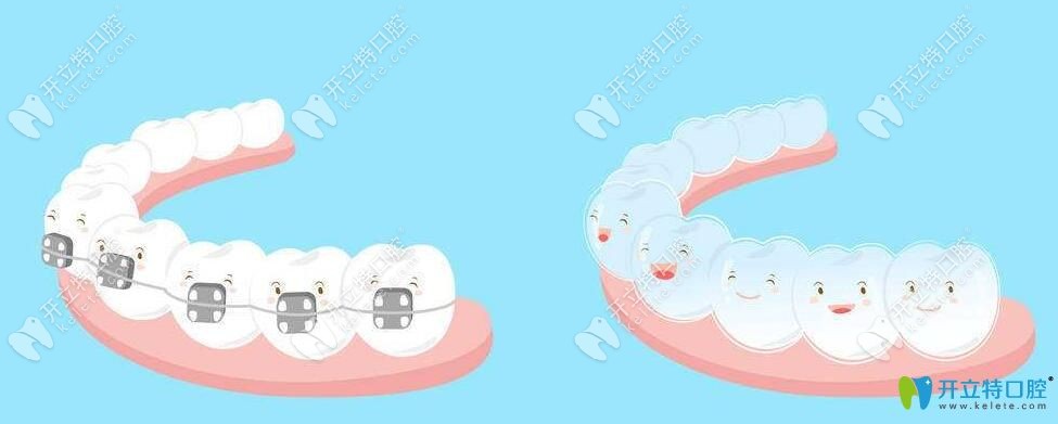 掩饰性正畸是什么意思