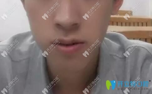 小哥哥骨性地包天矫正掩饰性正畸案例效果照