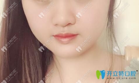 骨性地包天掩饰矫正案例效果照片