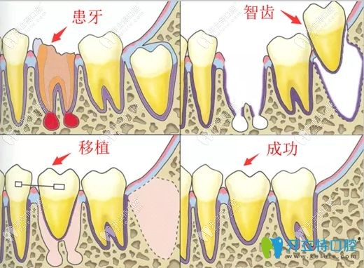 自體牙移植過程圖解
