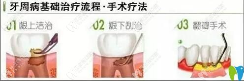 牙周病的治療方法
