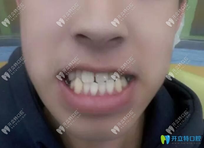 小哥哥骨性地包天矫正掩饰性正畸案例前样子