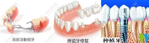 種植牙、活動(dòng)假牙和烤瓷牙哪個(gè)好