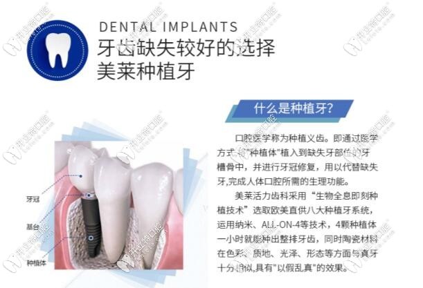 什么是種植牙科普