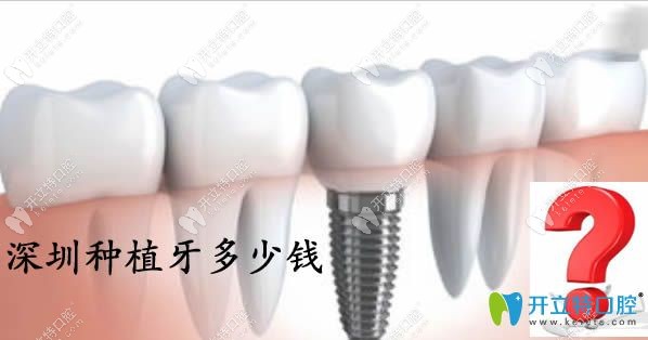 深圳種植牙多少錢