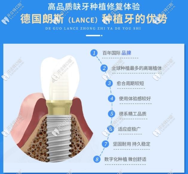 德系高端進(jìn)口種植牙朗斯Lance多少錢一顆