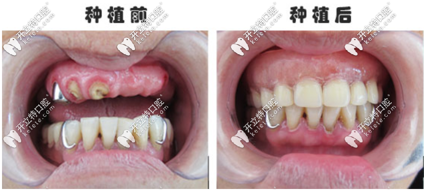 種植牙前后對比圖