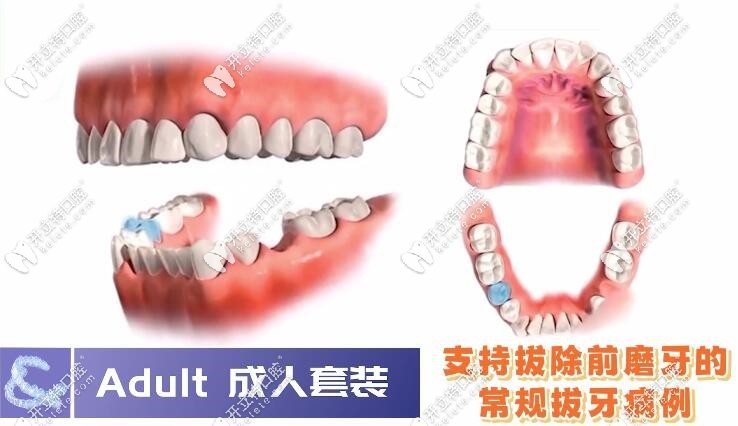 隱適美Adult成人套裝的適應(yīng)癥介紹