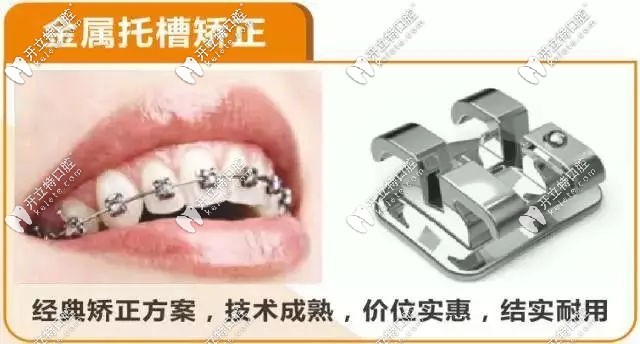 傳統(tǒng)金屬托槽矯正優(yōu)勢