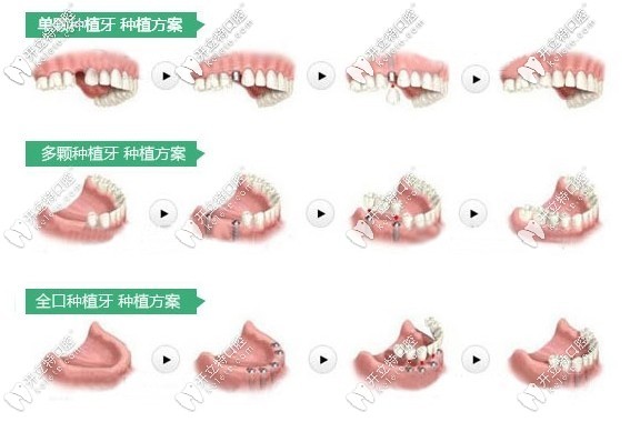 全口/半口種植牙圖示