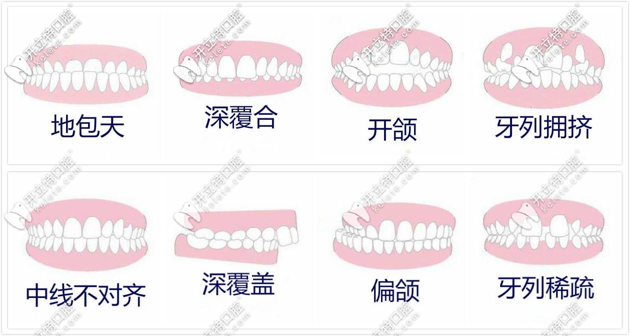 牙齒矯正適應(yīng)癥