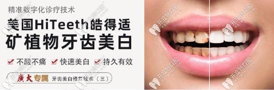 廣州廣大的美國HiTeeth皓得適牙齒美白的價(jià)格半價(jià)起