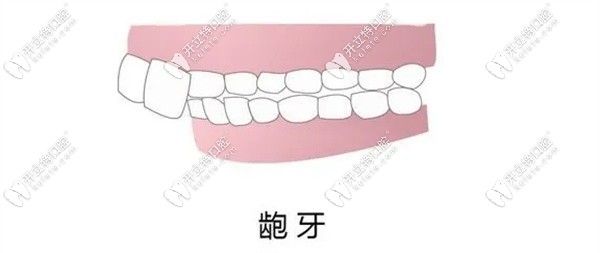 正畸為啥變成整齊的齙牙