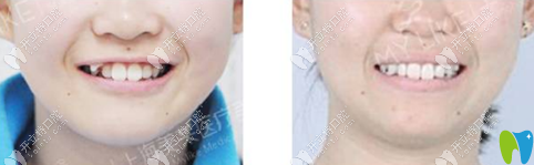 <!--<i data=20240703-sp></i>-->美萊口腔好嗎？來(lái)看魏東院長(zhǎng)正畸案例
