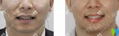 美萊口腔齙牙牙齒不齊矯正案例前后對(duì)比圖