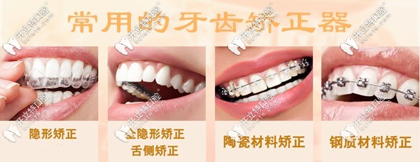 深圳盐田区牙科常用的牙齿矫正器