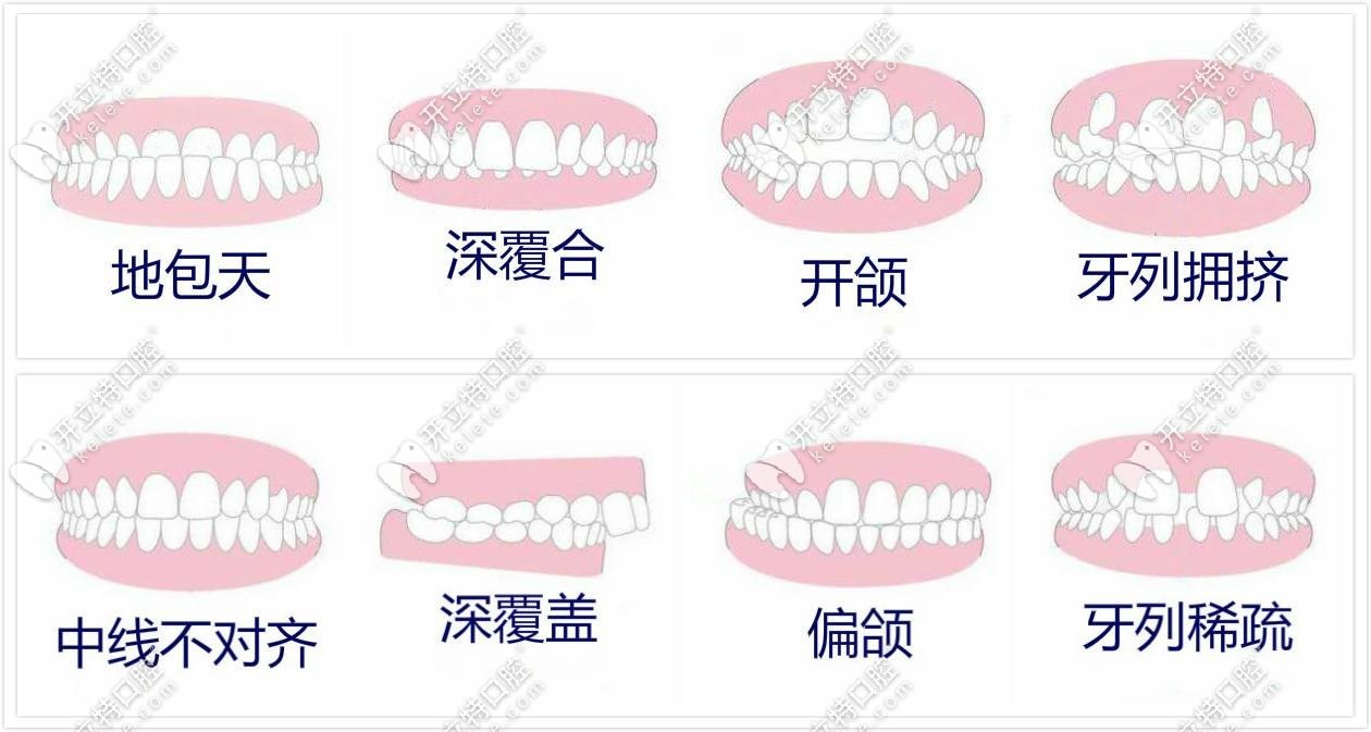 牙齿矫正适应症www.kelete.com