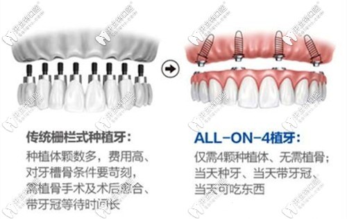 全口種植牙選傳統(tǒng)和allon4哪個(gè)好