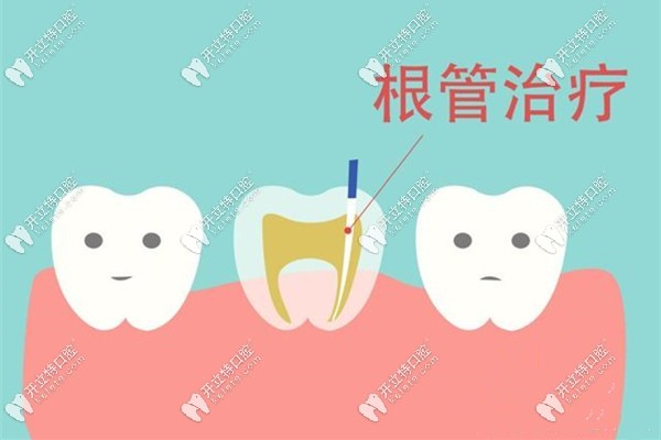 牙髓炎和根尖炎的治療方法