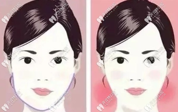 骨性偏頜如何避免越來越歪呢