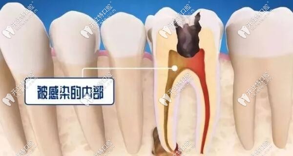牙髓炎和根尖炎的區(qū)別