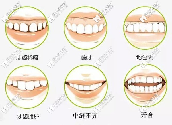什么樣的牙齒需要做正畸