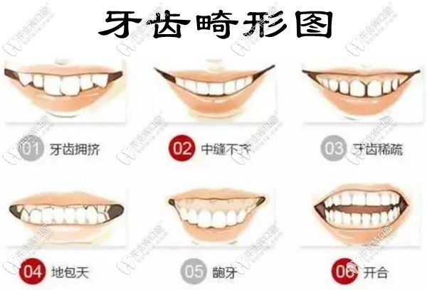 牙齒畸形圖