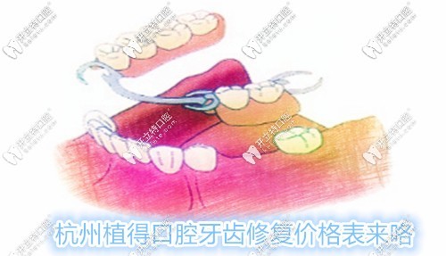 杭州植得口腔修復(fù)價(jià)格表