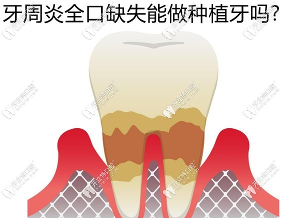 牙周炎全口缺失能做種植牙嗎?