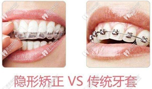 隱形和金屬矯正器哪個好