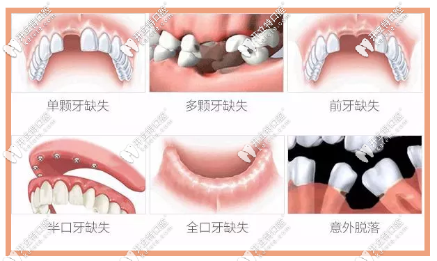 種植牙適應(yīng)癥