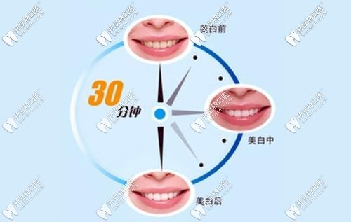 牙齒美白5.2折