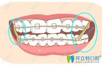 牙齿矫正橡皮筋吃饭刷牙