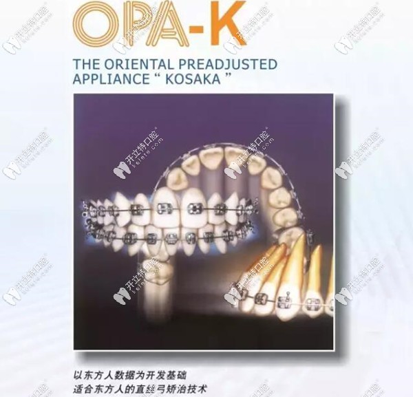 日本拓美OPA-K直絲弓自鎖矯治技術(shù)