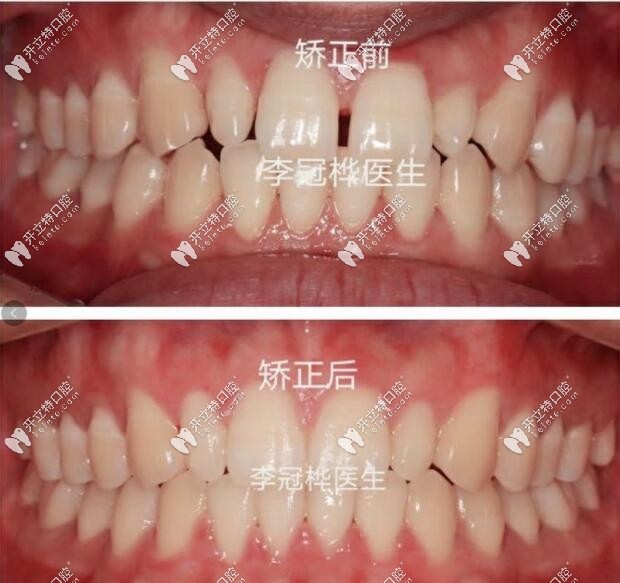 藍天口腔牙齒矯正效果