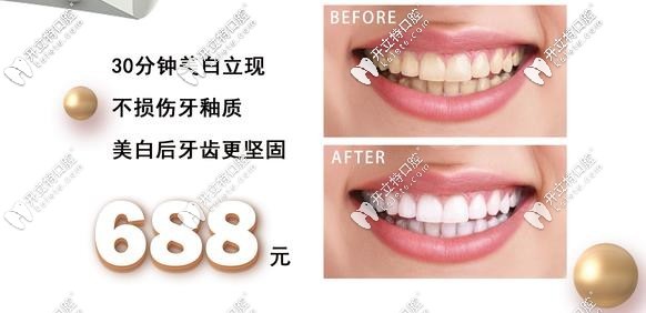 冷光美白價(jià)格僅要688元起