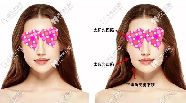 正畸后面部凹陷多是因?yàn)槌霈F(xiàn)牙套臉