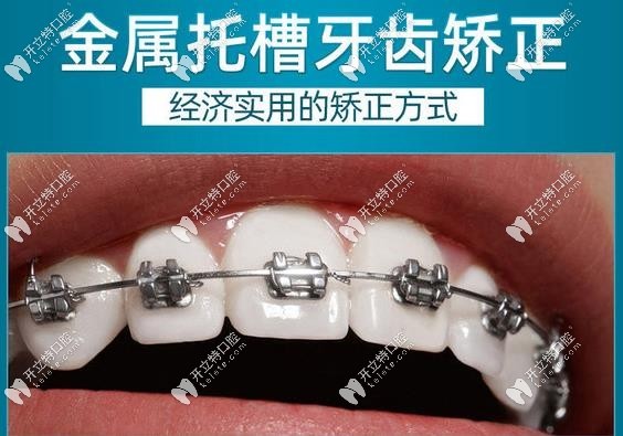三明梅列瑞爾口腔金屬托槽矯正價(jià)格