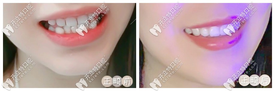 在美奧口腔做矯正的前后對比圖
