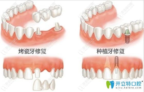 種植牙修復和烤瓷牙修復的對比圖