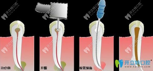 根管治療分幾個(gè)步驟