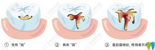 蛀牙的發(fā)展過(guò)程