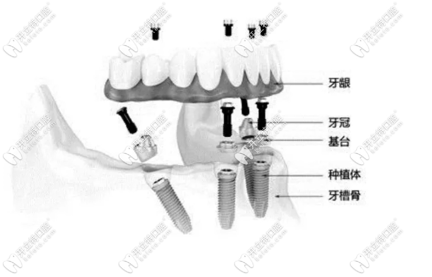 邵陽洞口縣口腔醫(yī)院種植牙價格在5000-13800元起一顆