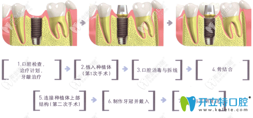 <!--<i data=20240703-sp></i>-->口腔种植牙