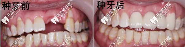 湛江致美口腔的種牙案例
